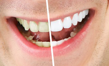 Get Healthier, Whiter Teeth — the Safe Way