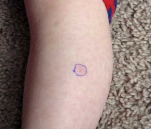 Circled bug bite