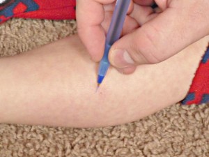Circling the bug bite